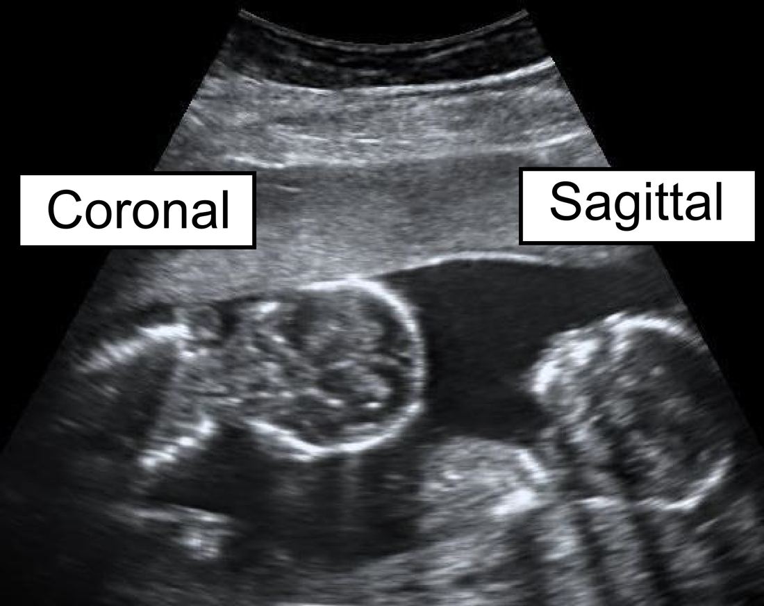 Grayscale ultrasound scan showing two identical twin fetuses side by side, labeled coronal and sagittal