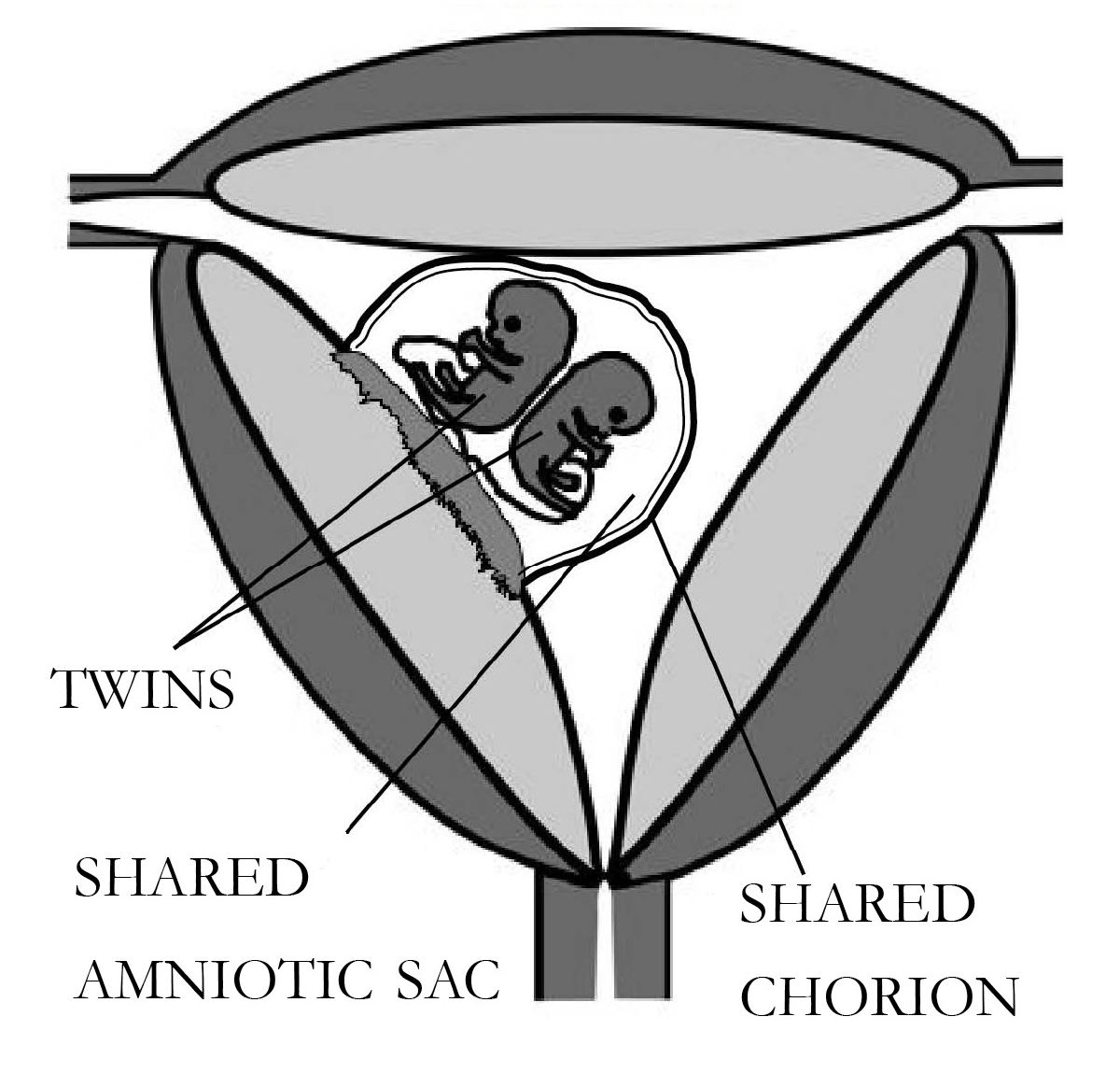 Black and white diagram of a womb holding two small embryos inside one shared amniotic sac and one shared chorion